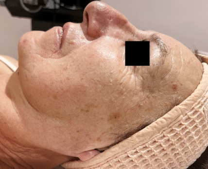 Skin infusion experte
