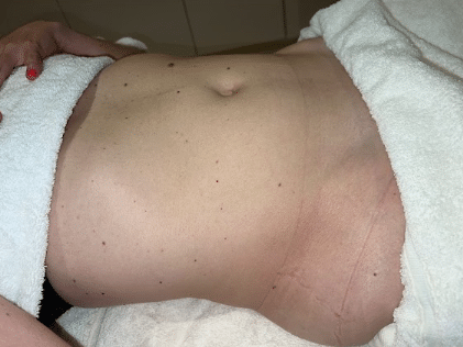 dainage lymphatique 4